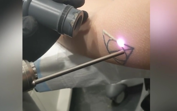 Cận cảnh tia laser loại bỏ hình xăm Harry Potter trên cơ thể người